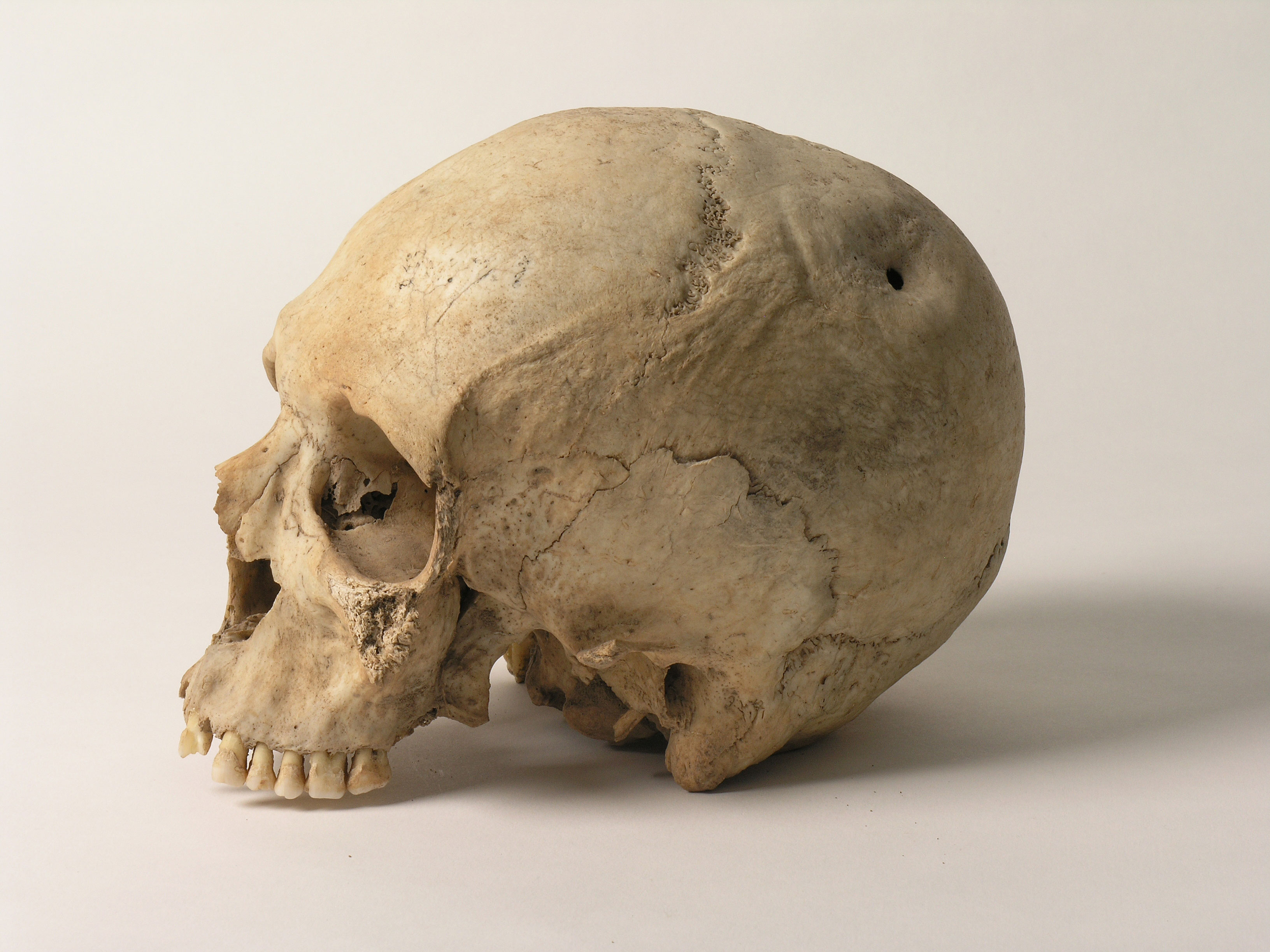 Crani trepanat. Eneolític